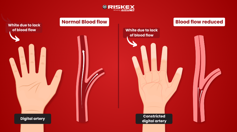 Diagram showing the constriction of the blood flow in the digital artery of a hand - Raynaud's