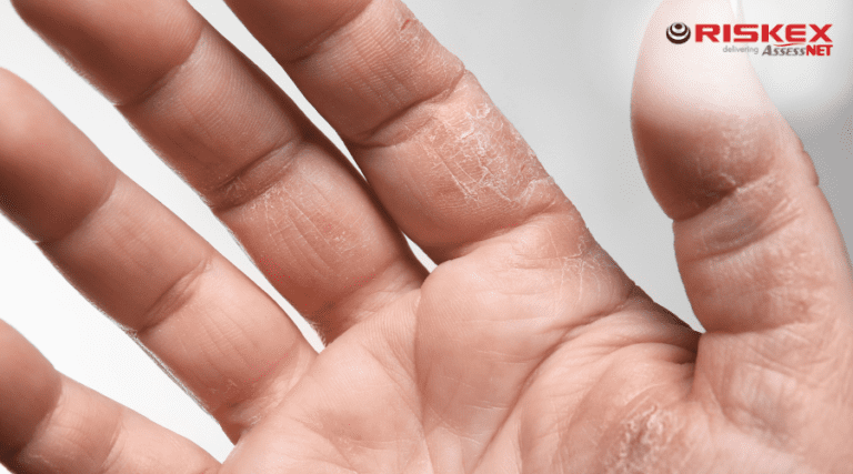 Dermatitis on hands